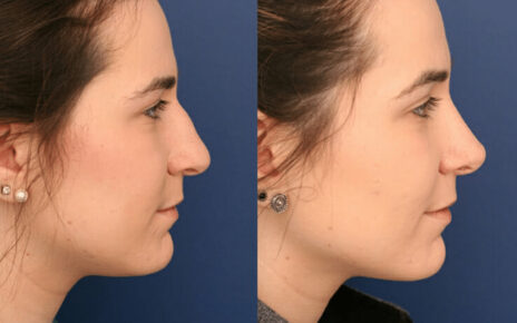 Transform Your Profile The Breakthrough Technique of Nasal Augmentation Using Bone Grafts from Behind the Ear