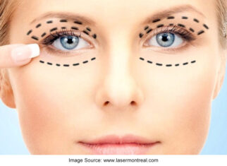 Planning for Blepharoplasty Determining the Ideal Age for It 
