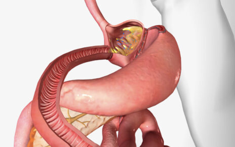 Transforming Lives Through Gastric Bypass Surgery A Journey Towards Health and Confidence